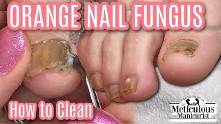 👣Pedicure for Men How to Clean Orange Nail Fungus Off Toenails👣