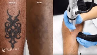 MY LASER TATTOO REMOVAL EXPERIENCE (After 8 treatments)