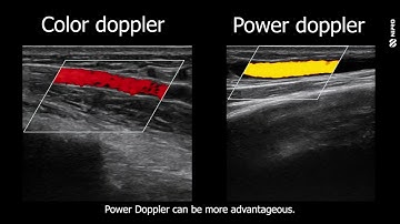 iMEP Tips & Tricks 30: Power Doppler vs. Color Doppler