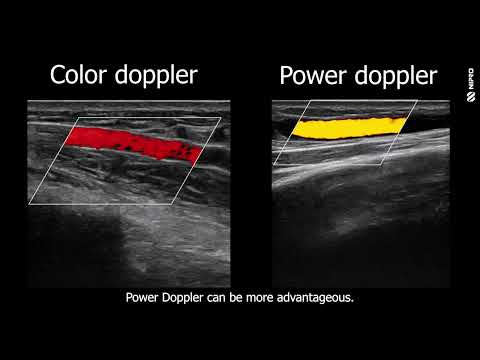 iMEP Tips & Tricks 30: Power Doppler vs. Color Doppler - video from Nipro