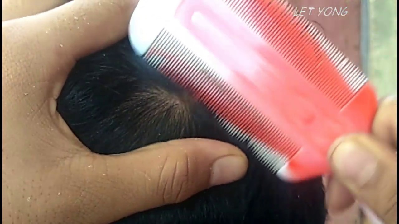 Dandruff Scratching Treatment Dandruff Scratching With Lice Comb