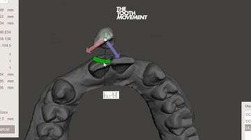 Provisional Anterior Tooth Replacement with Meshmixer