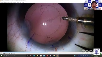 AIOS ARC - Cataract Surgery in Complexities - A Learning-Dr.Sanjay Chaudhary
