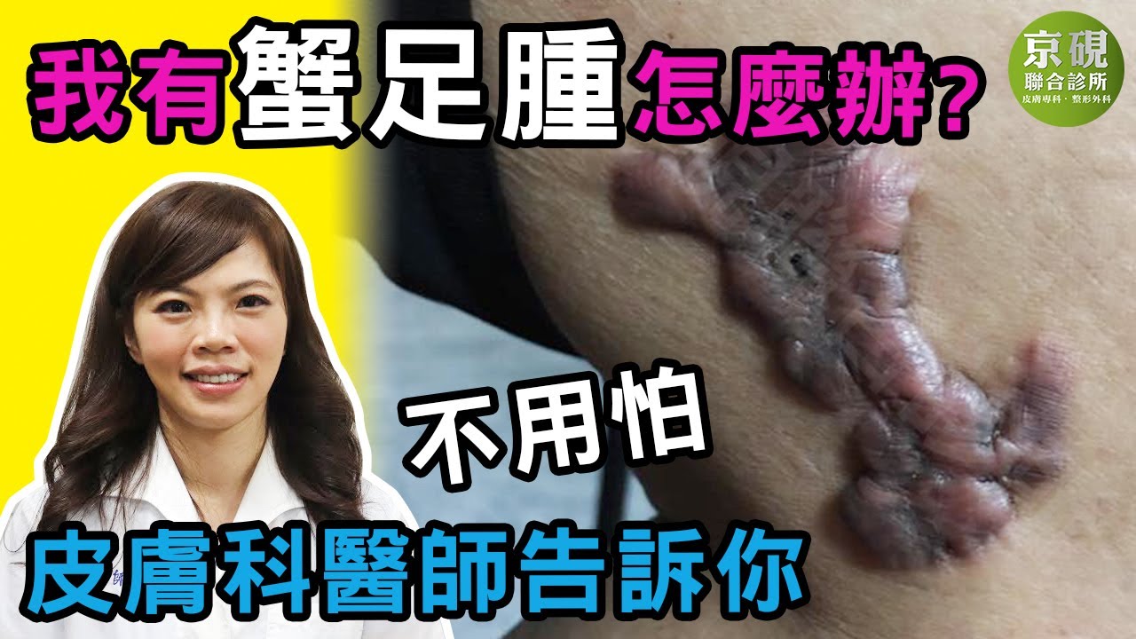 我有 蟹足腫怎麼辦 不用怕 皮膚科醫師告訴你 Youtube