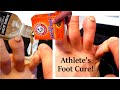 👣 Athlete's Foot Part 3: Baking Soda + Rubbing Alcohol = CURE?? I Think So!