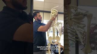 Diffuse Idiopathic Skeletal Hyperostosis and Physical Therapy