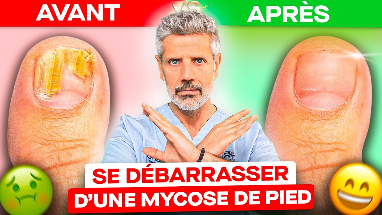 Mycose au Pied : Comment l'Éviter & la Soigner ?