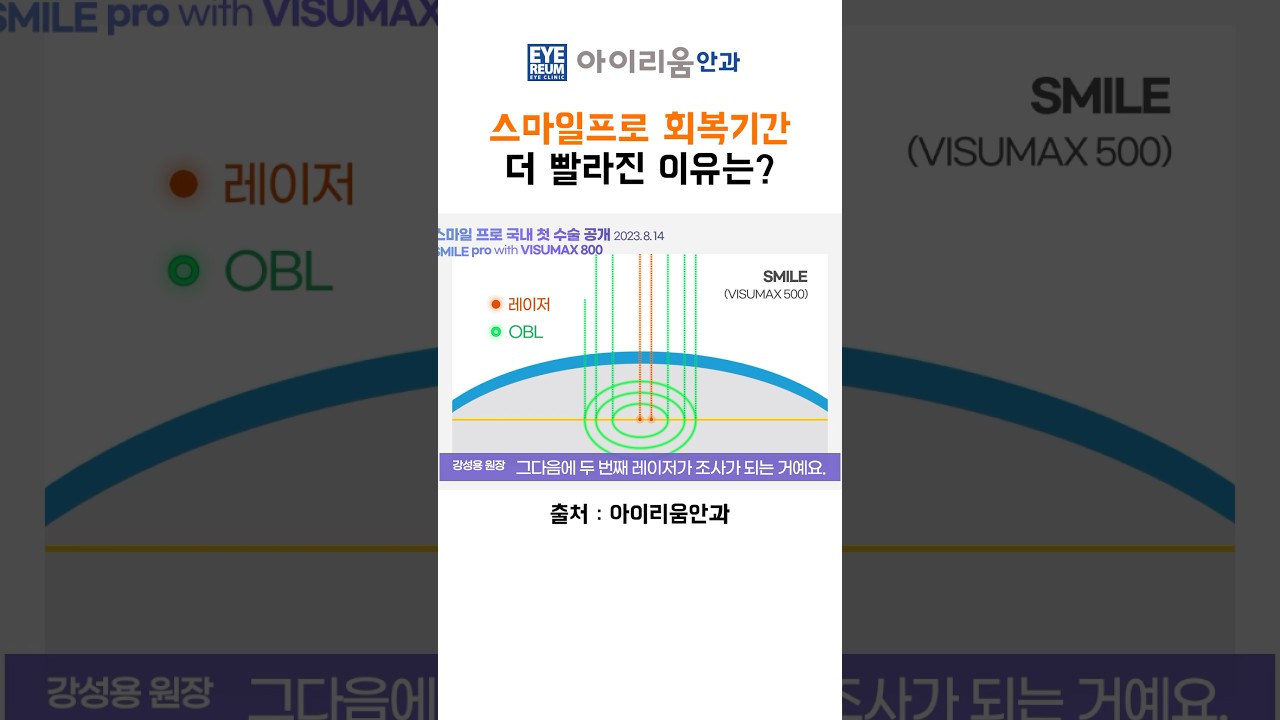 [艾利優眼科診所] #微笑雷射專業版恢復期快速的原因？ #微笑雷射專業版 手術當天視力1.0