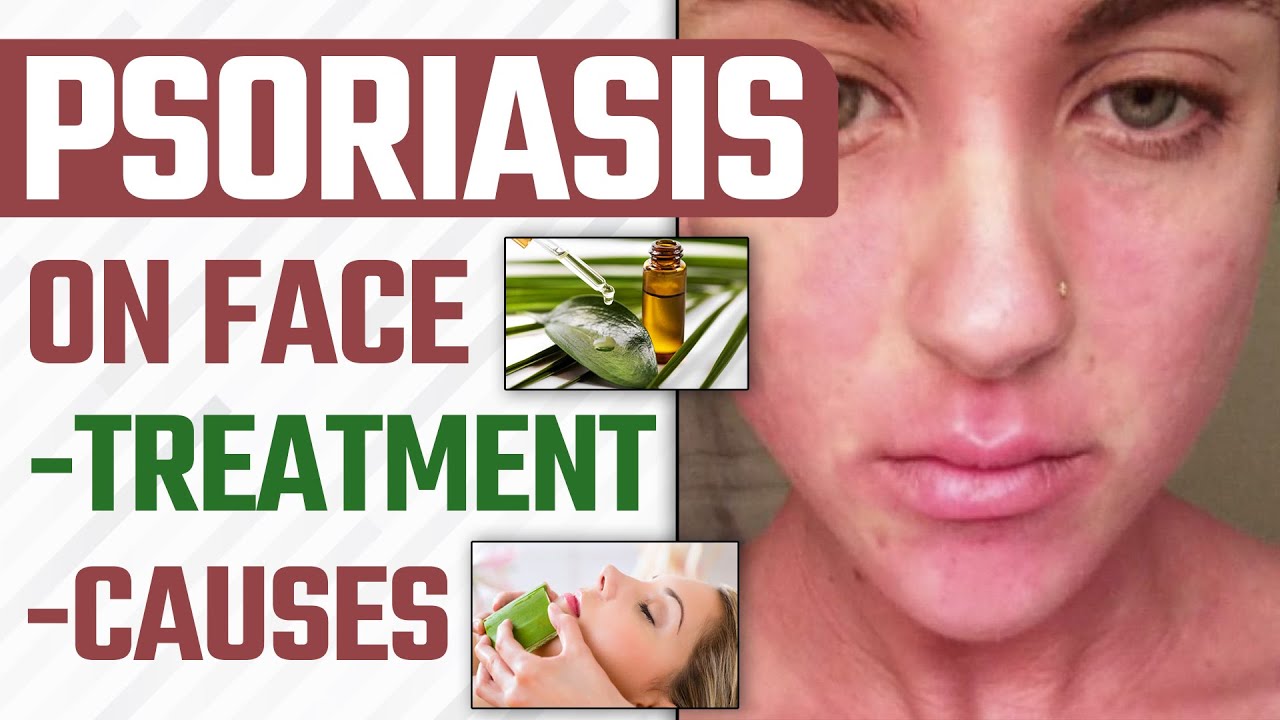 Psoriasis on Face Treatment, Causes चेहरे के सोरायसिस का इलाज Dr