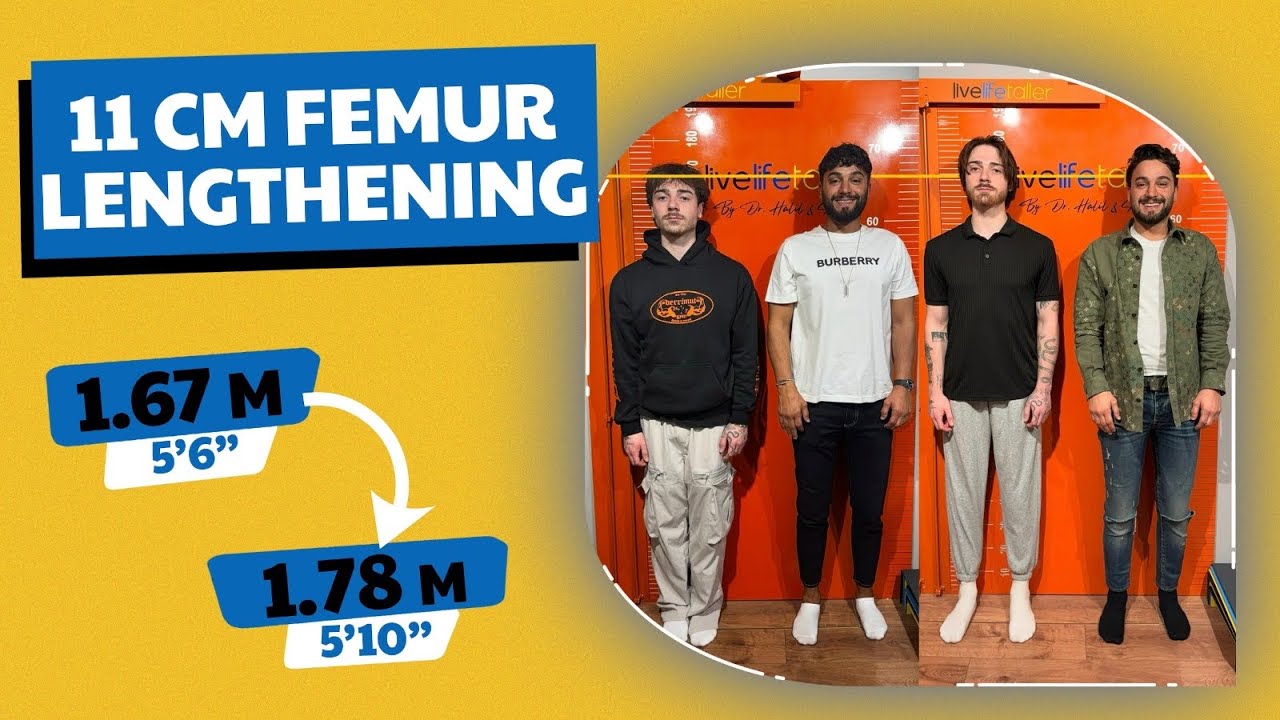 LUCAS’ FINAL INTERVIEW: FROM 1.67 M (5’6”) TO 1.78 M (5’10”) — 11 CM FEMUR LENGTHENING