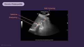 Gallbladder Pathology On Sonography Identify Inflammation U0026 Emergency Findings Quickly