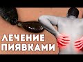 Гирудотерапия. Показания. Как проводится процедура. Побочные эффекты.