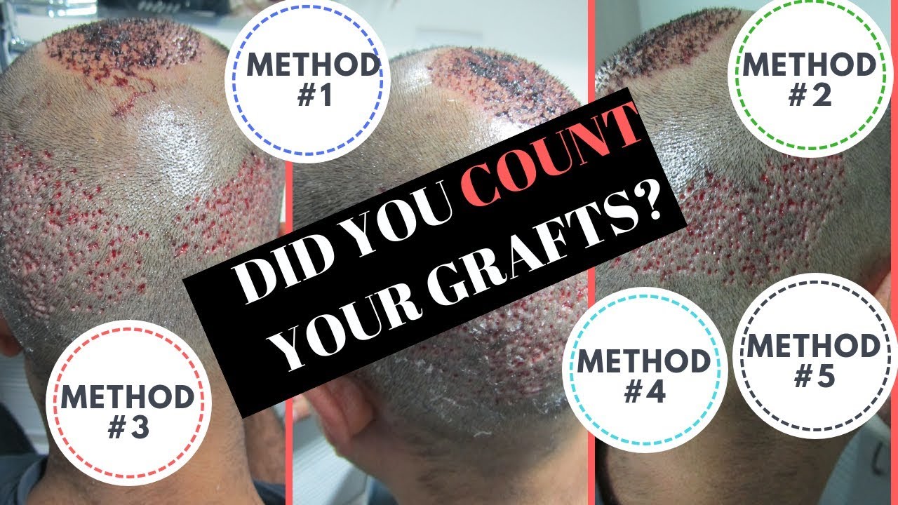 HOW TO count grafts during and after hair transplant & avoid cheating