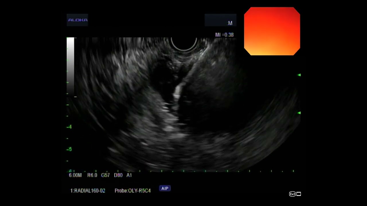 Walled off pancreatic necrosis