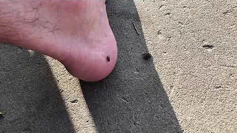 Spider attacks and eats off of mans foot.