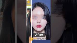 Korean Double Jaw Surgery + V-Line Surgery Surgery Results | (Before & After)