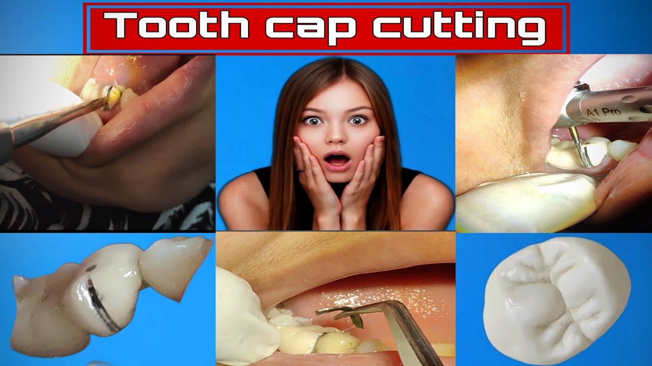 Tooth cap cutting &remove painless🦷 - YouTube
