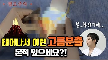 [혐오주의] 염증성 표피낭종(피지낭종)의 최후! 태어나서 이런 고름분출 본적 있으세요?![squeeze the pus]