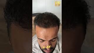 6.Ay Saç Eki̇mi̇ Sonrasi Muhteşem Deği̇şi̇m & Ers Cli̇ni̇c