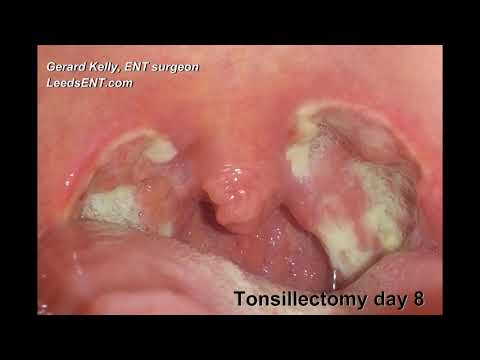 tonsillectomy time lapse day 1 to 27