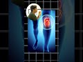 क्या Cartilage Damage होने पर Knee Replacement ज़रूरी है? #aclrecovery #physiotherapist