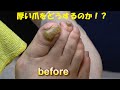 肥厚爪の施術【厚い爪のケア】（Thickened nails・THICK TOENAIL・두꺼워 손톱）008