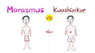 Marasmus vs. Kwashiorkor - Protein Energy Malnutrition - Gastroenterology