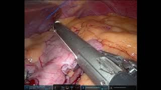 Robotic Roux-en-Y gastric bypass