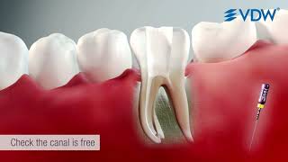 VDW Dental · How To: Root canal preparation with RECIPROC blue R25