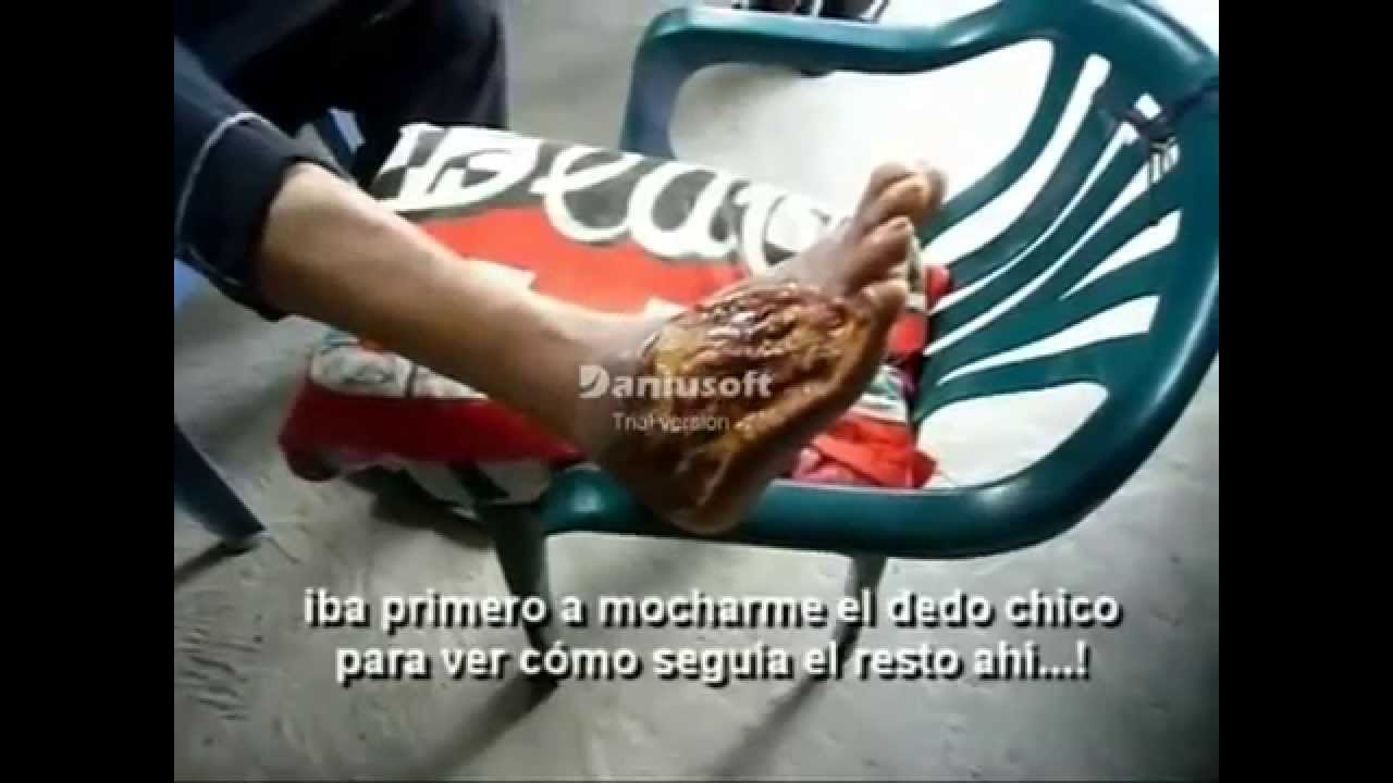 DIABETES PIE CON GANGRENA TESTIMONIO OMNILIFE YouTube