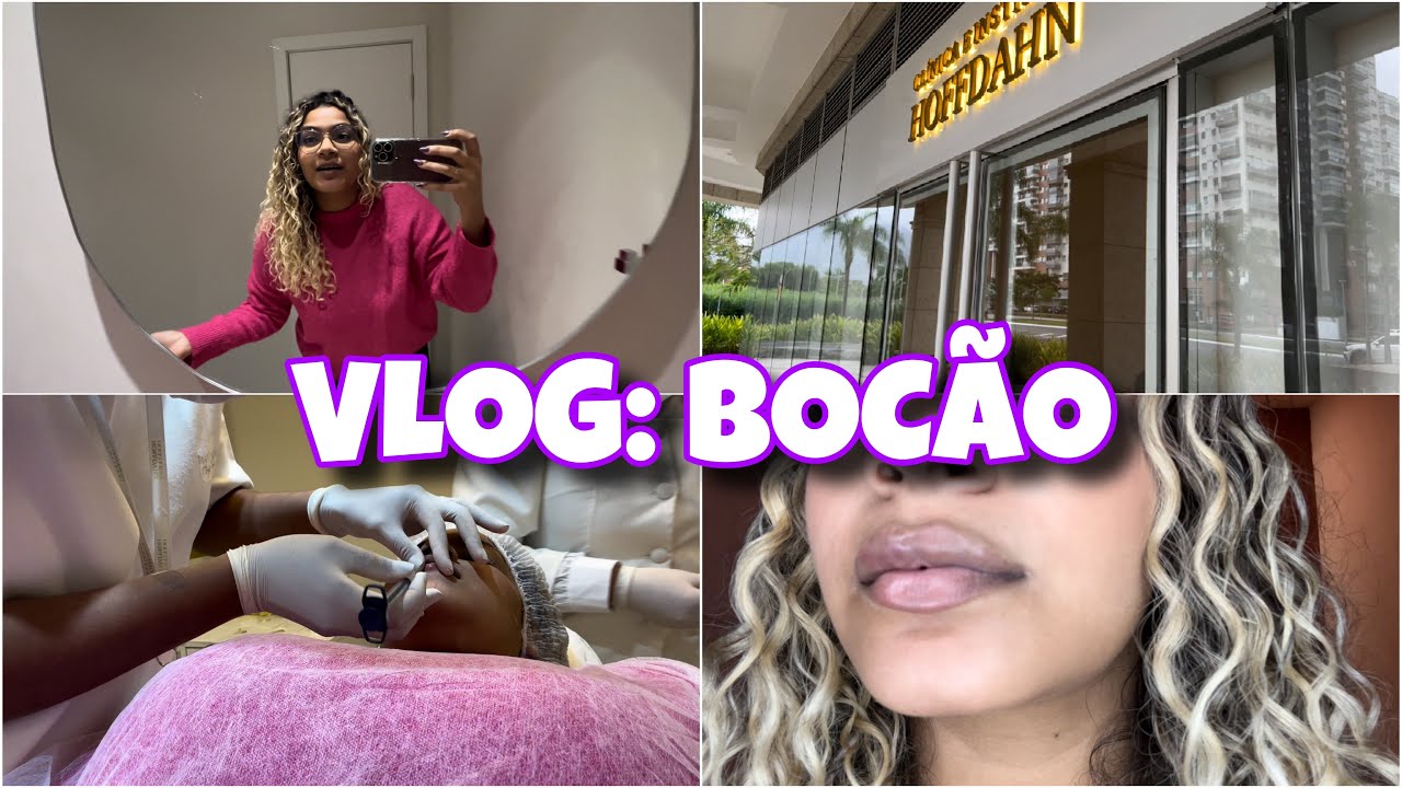 VLOG: MEU PRIMEIRO PROCEDIMENTO ESTÉTICO - PREENCHIMENTO LABIAL (E RESULTADO FINAL)