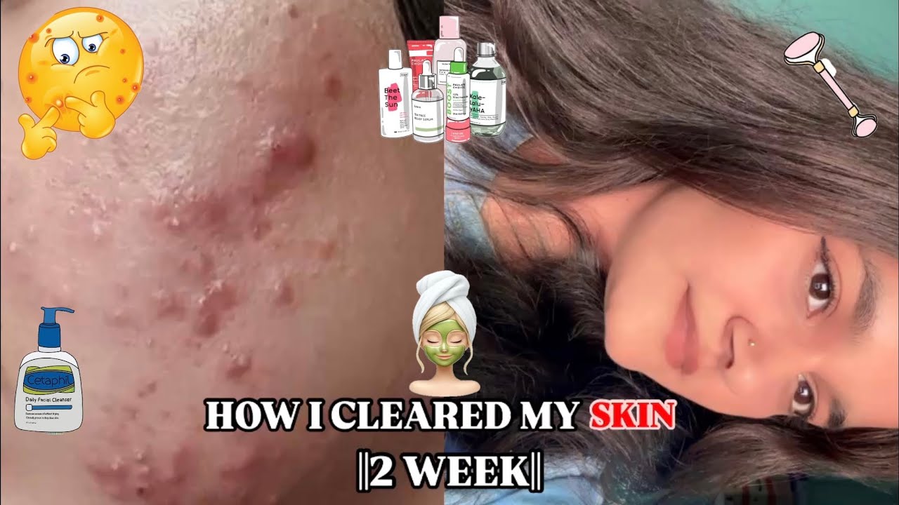 HOW I CLEARED MY ACNE IN 2 WEEKS*affordable & effective* (NOT CLICKBAIT ...