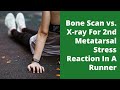 Bone Scan vs. X-ray For 2nd Metatarsal Stress Reaction In A Runner