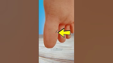 How to Remove a Splinter Without Pain (Easy Method)