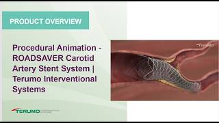 Procedural Animation -  ROADSAVER Carotid Artery Stent System | Terumo Interventional Systems