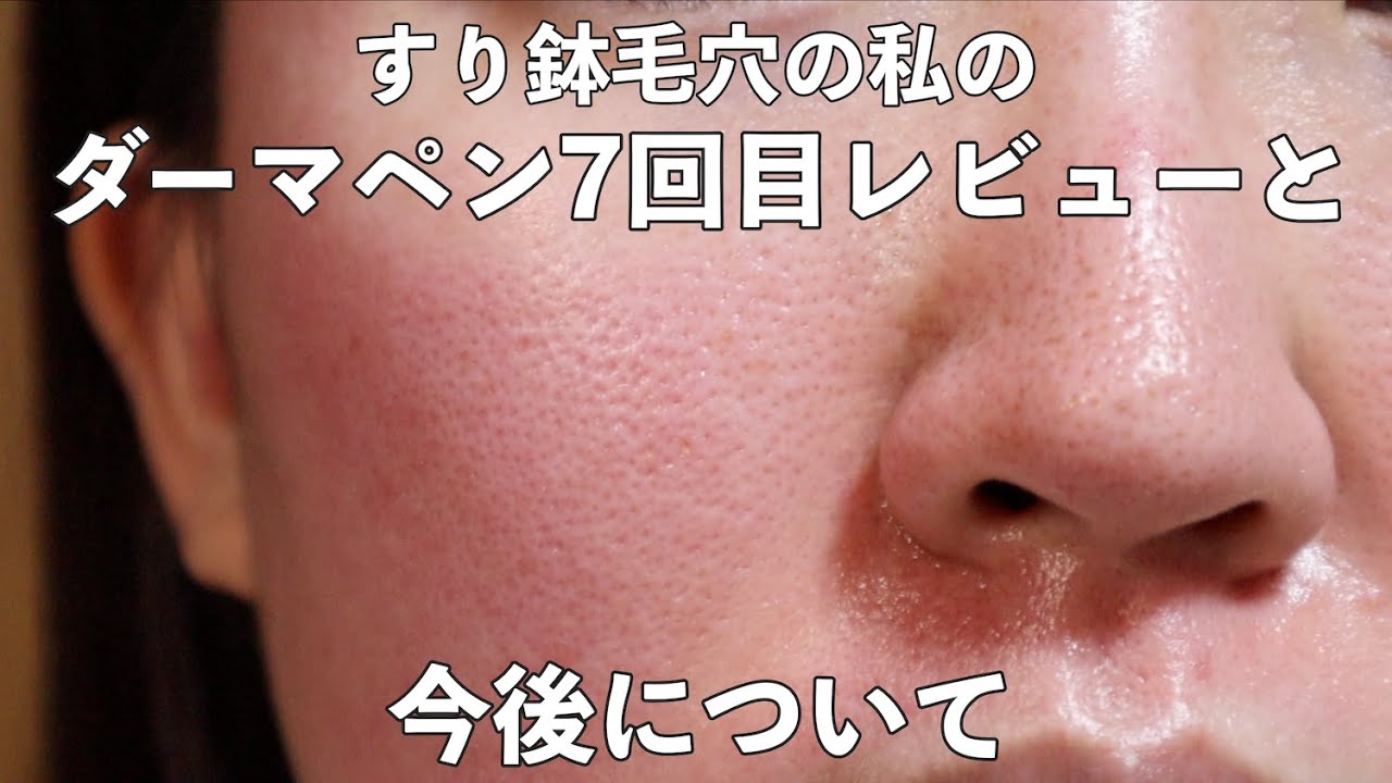 閲覧注意 ダーマペン4の2回目を2mmで受けてきました 値段 施術 経過についてお話しします すり鉢毛穴 毛穴 毛穴の開き いちご鼻 ニキビ跡 角栓 黒ずみ 皮剥け 赤み Dermapen 4 Youtube
