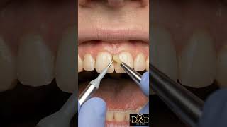 caries interproximal anteriror