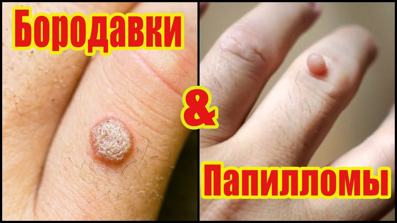 Что такое папилломы и бородавки? Как отличить папиллому от бородавки ...