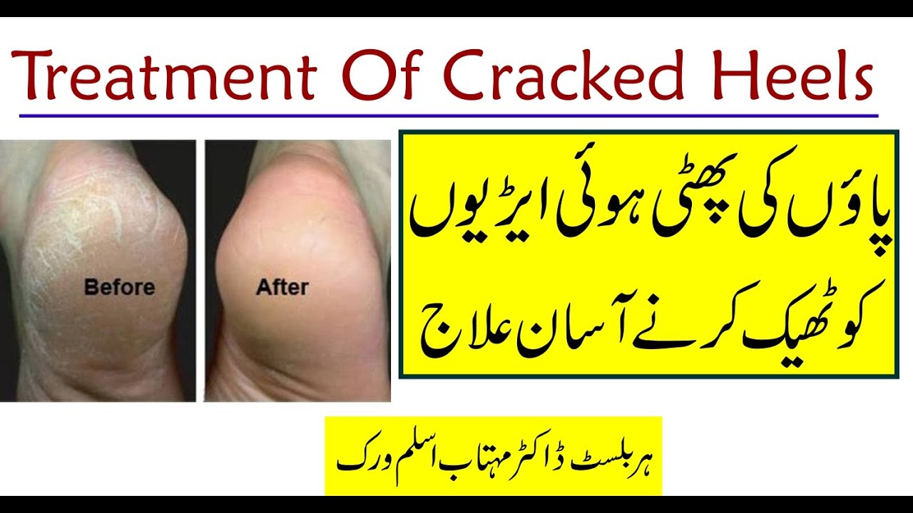 How to Heal Cracked Heels | Cracked Heels Remedy |Home Remedies to Remove Cracked Heels by:Dr