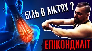 Епікондиліт - вирішення проблеми