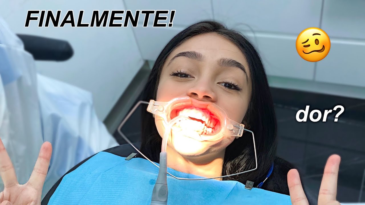 COLOQUEI APARELHO ORTODÔNTICO AUTOLIGADO!! doeu?