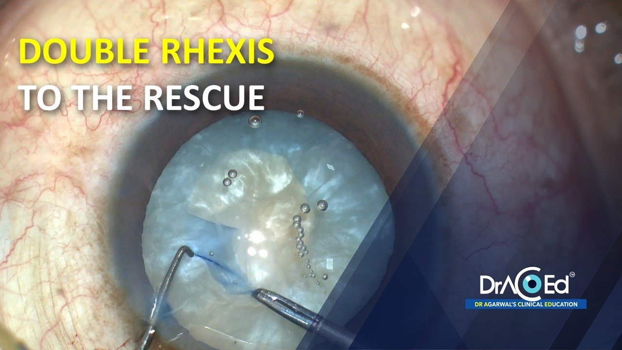 Small Rhexis 52 | DOUBLE RHEXIS TO THE RESCUE - YouTube
