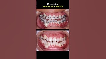 Braces evelution. Severe underbite teeth #braces #dentist #orthodontist