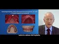 Clase Implantología dental | slescción de implante.