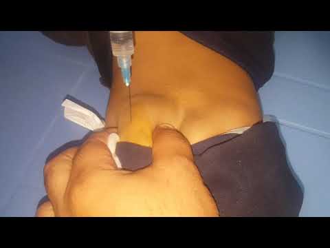 زرق ابره مباشر للاطفال