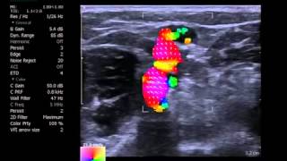 VFI imaging of turbulent flow in an arm vein and its tributa