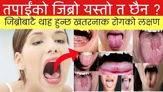 कतै तपाईंको जिब्रो यस्तो त छैन ? तपाईं ठूलो रोगको संक्रमणमा हुनुहुन्छ | Symptoms of tongue problems