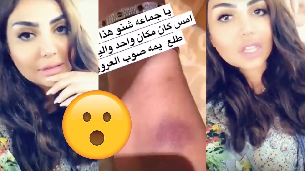 أمل العوضي تعرض كدمات في جسمها ومصدومة