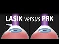 Lasik or prk which is right for me animation