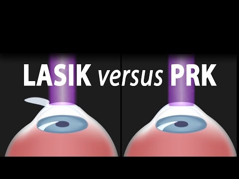Video: PRK Vs. LASIK: Diferențe, Argumente Pro, Contra și Ce Trebuie Să Te Aștepți